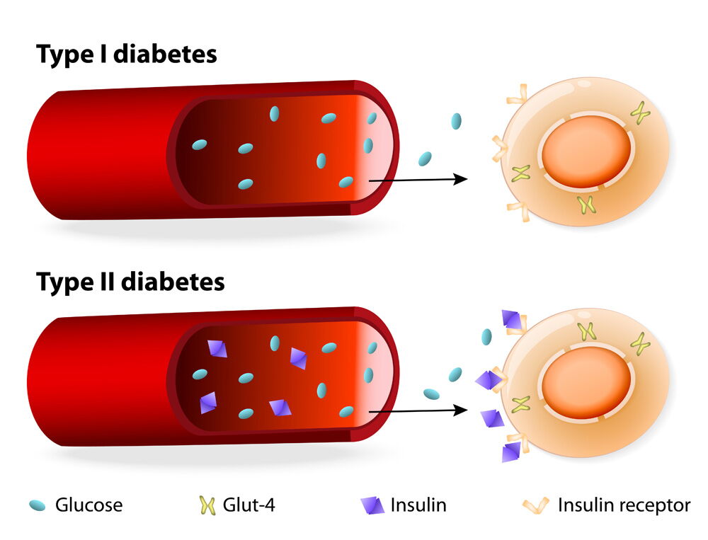 Types of diabetes and insufficient production of insulin