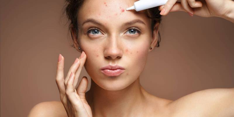 Acne: natural remedies to cure