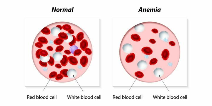 anemia