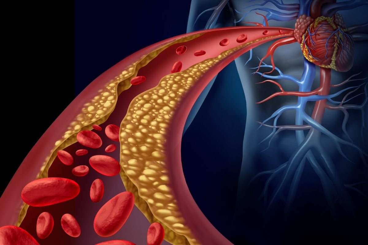 colesterolo cattivo che si accumula nelle vene