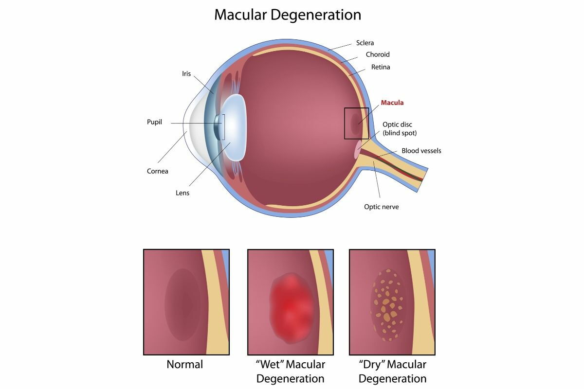 degeneración macular