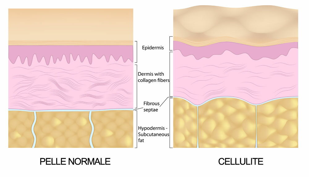 Stadi di progressione della cellulite
