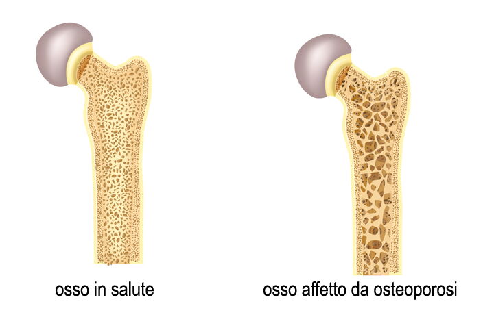 ossa affette da osteoporosi