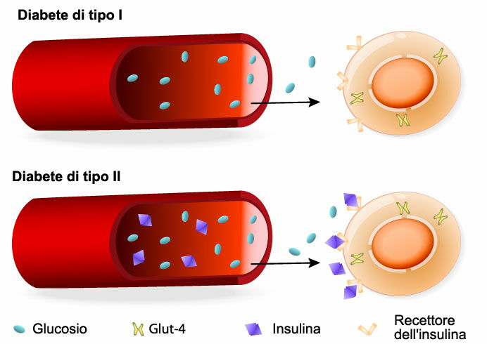 Tipologie di diabete e la produzione insufficiente di insulina