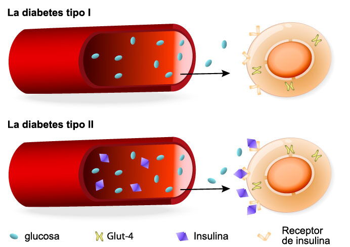 Tipos de diabetes y producción insuficiente de insulina