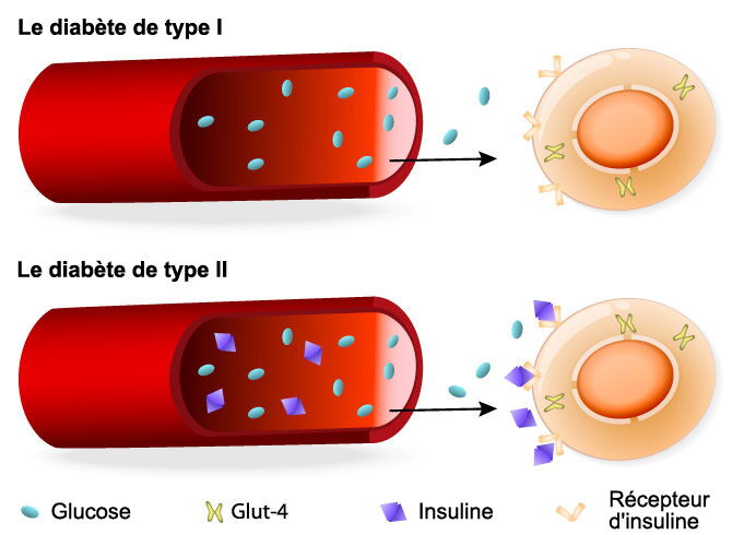Typologies du diabète et production insuffisante d'insuline