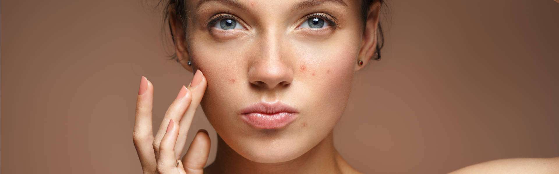 Acne: natural remedies to cure